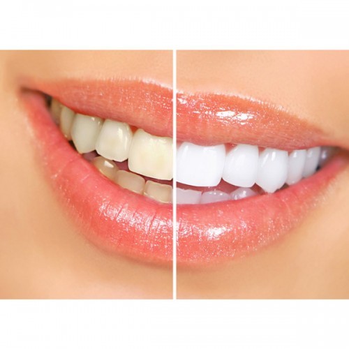 Trake za izbeljivanje zuba - Ultra White 7 dana
